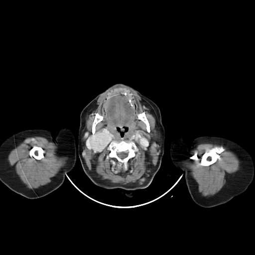 File:Carotid body tumor (Radiopaedia 21021-20948 A 15).jpg