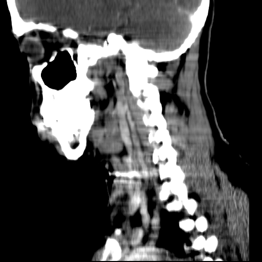 File:Carotid body tumor (Radiopaedia 27890-28124 C 7).jpg