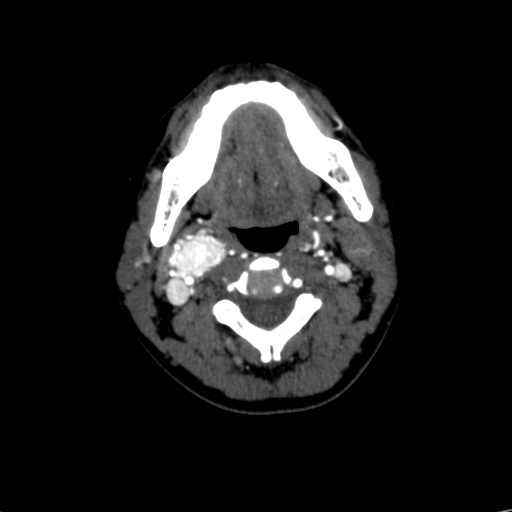File:Carotid body tumor (Radiopaedia 39845-42300 B 46).jpg