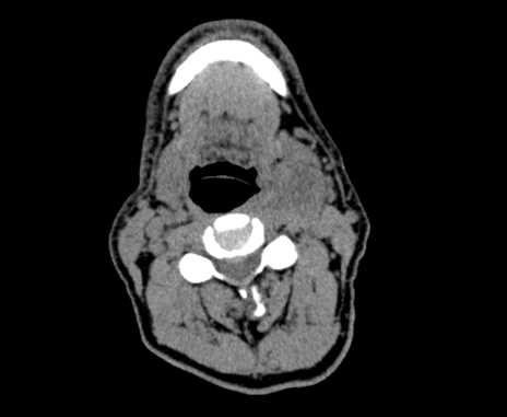 Carotid body tumor (Radiopaedia 61750-69757 Axial non-contrast 47).jpg