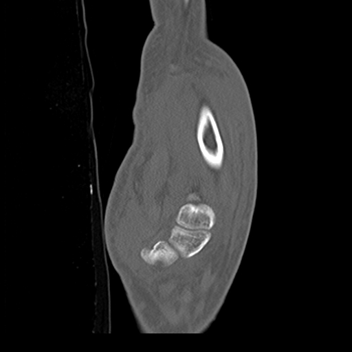 File:Carpo-metacarpal fracture-dislocations with hamatum split fracture (Radiopaedia 18482-18343 Sagittal bone window 21).jpg