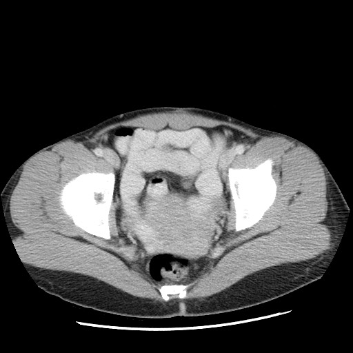 Castleman disease with fibrous pseudotumor in the abdomen (Radiopaedia 77296-89373 A 114).jpg