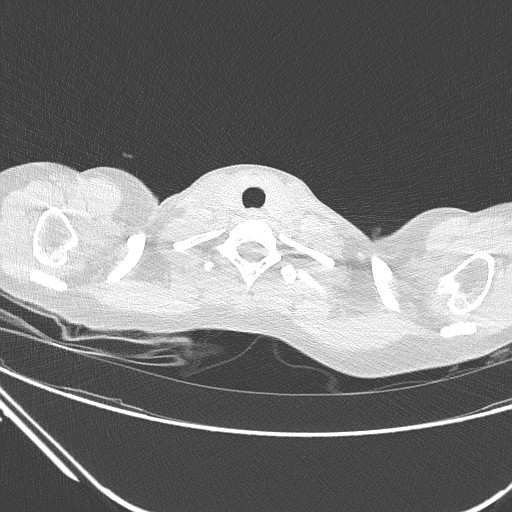 Catamenial pneumothorax (Radiopaedia 27946-28197 lung window 13).jpg