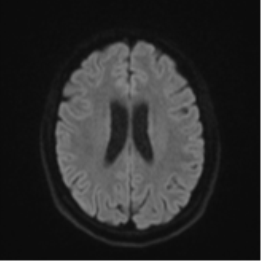 File:Cavernoma with bleed - midbrain (Radiopaedia 54546-60774 Axial DWI 45).png