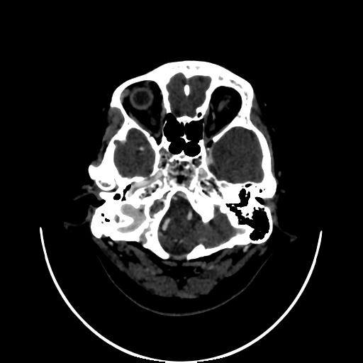 Cavernoma with developmental venous anomaly (Radiopaedia 22470-22506 C 15).jpg