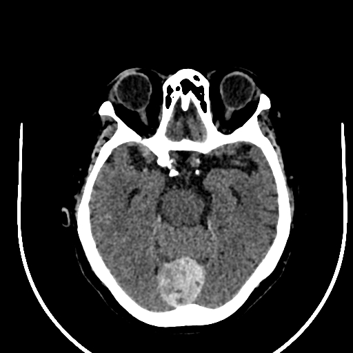 File:Cavernous hemangioma of the cerebellar falx (Radiopaedia 73025-83723 Axial non-contrast 51).jpg