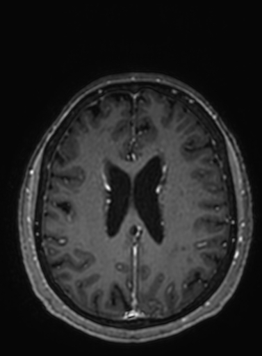 Cavernous hemangioma of the cerebellar falx (Radiopaedia 73025-83724 Axial T1 C+ 118).jpg