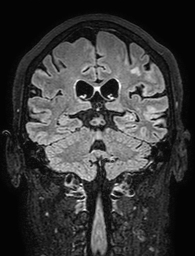 Cavernous hemangioma of the cerebellar falx (Radiopaedia 73025-83724 Coronal FLAIR 220).jpg