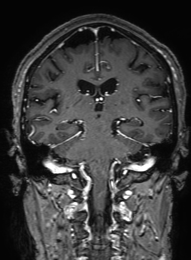 Cavernous hemangioma of the cerebellar falx (Radiopaedia 73025-83724 Coronal T1 C+ 223).jpg