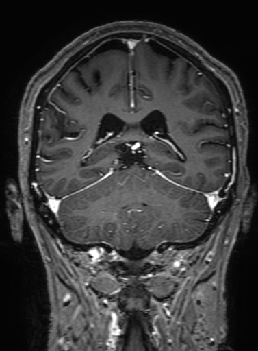 Cavernous hemangioma of the cerebellar falx (Radiopaedia 73025-83724 Coronal T1 C+ 252).jpg