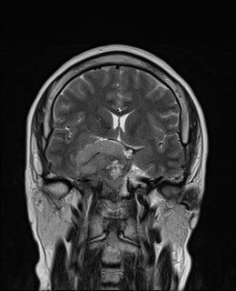File:Cavernous sinus meningioma (Radiopaedia 63682-72367 Coronal T2 6).jpg