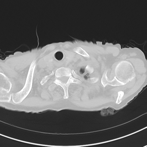 Cavitating pneumonia - lingular segments (Radiopaedia 34386-35678 Axial lung window 5).png
