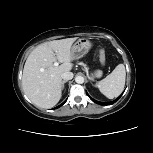 Cecal adenocarcinoma (Radiopaedia 75909-87331 A 26).jpg