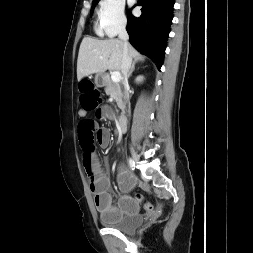 Cecal adenocarcinoma (Radiopaedia 75909-87331 C 33).jpg