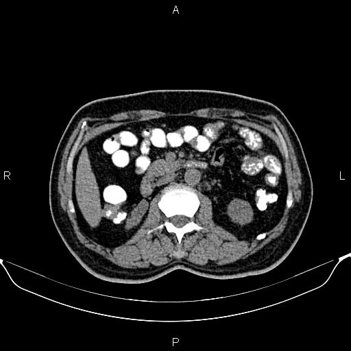 Cecal adenocarcinoma (Radiopaedia 85324-100916 Axial non-contrast 41).jpg