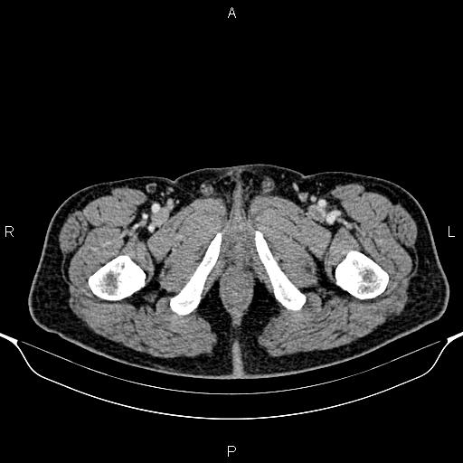 Cecal adenocarcinoma (Radiopaedia 85324-100916 B 108).jpg