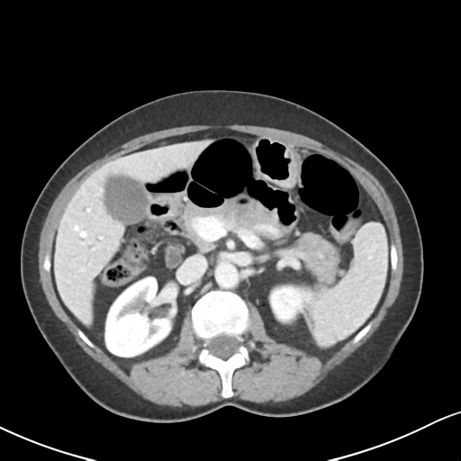 Cecal internal hernia through the foramen of Winslow (Radiopaedia 44820-48651 B 27).png