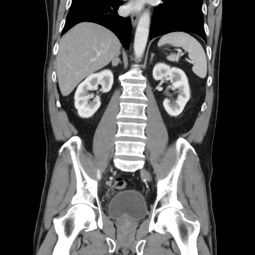 Cecal mass causing appendicitis (Radiopaedia 59207-66531 B 33).jpg