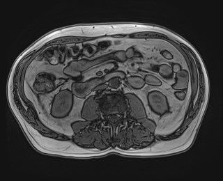 Cecal mass causing appendicitis (Radiopaedia 59207-66532 D 71).jpg