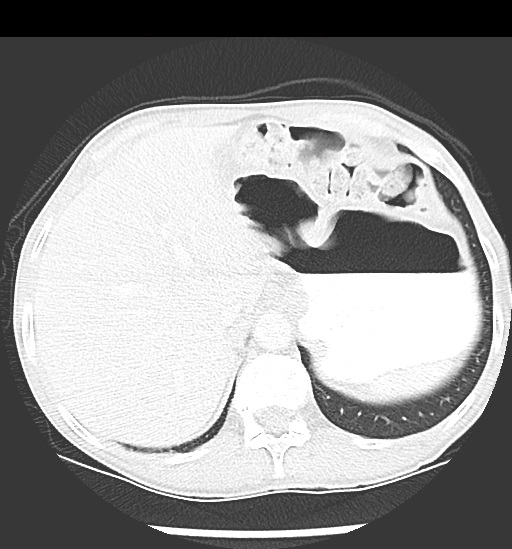 File:Cecal volvulus (Radiopaedia 48543-53513 Axial lung window 17).jpg