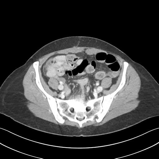 Cecum hernia through the foramen of Winslow (Radiopaedia 46634-51112 A 54).png