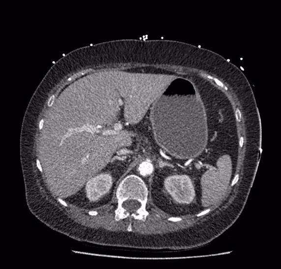 Celiac artery severe stenosis and dissection (Radiopaedia 44128-47842 B 22).jpg