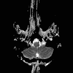 File:Central-variant posterior reversible encephalopathy syndrome (PRES) (Radiopaedia 43880-47358 Axial ADC 2).jpg