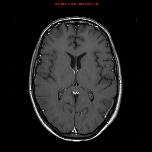 File:Central nervous system vasculitis (Radiopaedia 8410-9235 Axial T1 C+ 13).jpg