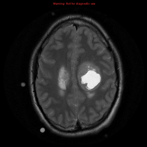 File:Central neurocytoma (Radiopaedia 13188-13206 Axial T2 7).jpg