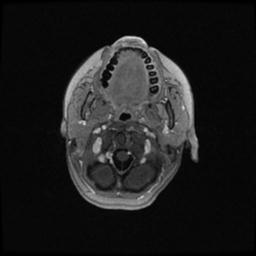Central neurocytoma (Radiopaedia 30220-30842 Axial T1 C+ 12).jpg