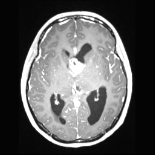 File:Central neurocytoma (Radiopaedia 37664-39557 Axial T1 C+ 40).png