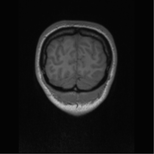 Central neurocytoma (Radiopaedia 37664-39557 Coronal T1 10).png