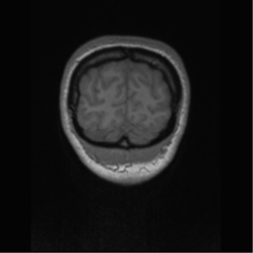 Central neurocytoma (Radiopaedia 37664-39557 Coronal T1 9).png