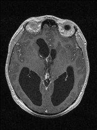 Central neurocytoma (Radiopaedia 56690-63469 Axial T1 C+ 74).jpg