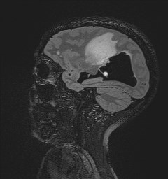 Central neurocytoma (Radiopaedia 84497-99872 Sagittal Flair + Gd 106).jpg