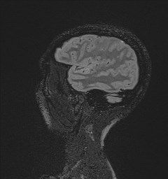 File:Central neurocytoma (Radiopaedia 84497-99872 Sagittal Flair + Gd 35).jpg