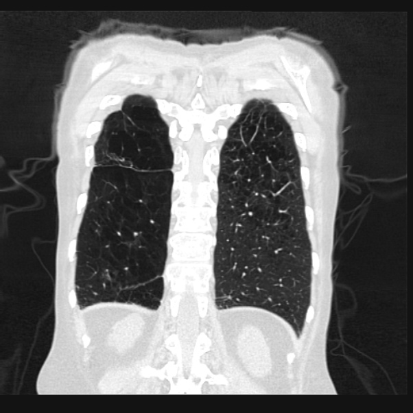 Centrilobular pulmonary emphysema (Radiopaedia 24495-24789 Coronal lung window 64).jpg