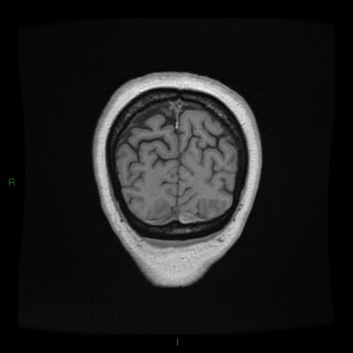Cerebellar abscess (Radiopaedia 78135-90678 Coronal T1 C+ 155).jpg