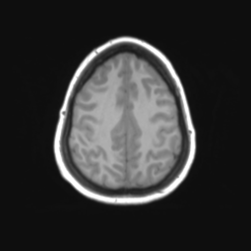 File:Cerebellar ependymoma complicated by post-operative subdural hematoma (Radiopaedia 83322-97736 Axial T1 32).png