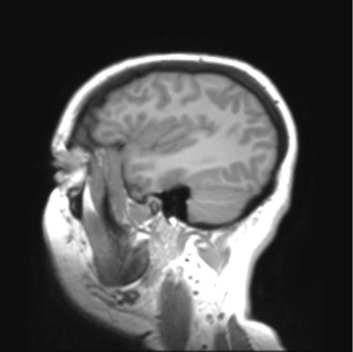 File:Cerebellar ependymoma complicated by post-operative subdural hematoma (Radiopaedia 83322-97736 Sagittal T1 9).png