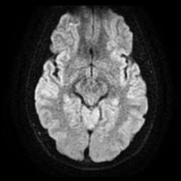Cerebellar hemangioblastoma (Radiopaedia 29570-30077 Axial DWI 12).jpg