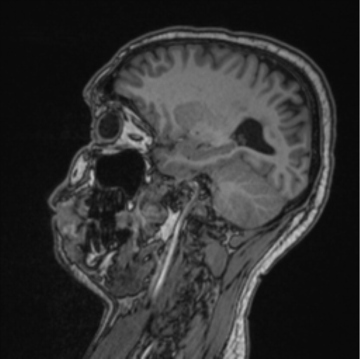 Cerebellar hemangioblastomas and pituitary adenoma (Radiopaedia 85490-101176 Sagittal T1 41).png