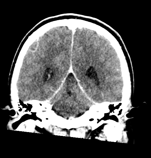 Cerebellar metastases - colorectal adenocarcinoma (Radiopaedia 40947-43652 Coronal C+ 60).png
