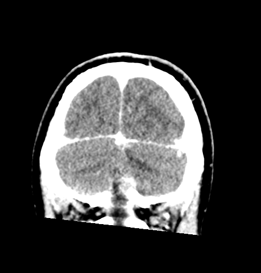 Cerebellar metastases - colorectal adenocarcinoma (Radiopaedia 40947-43652 Coronal C+ 79).png