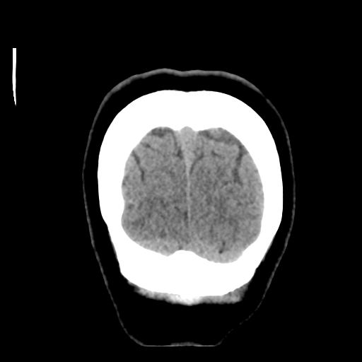 File:Cerebellar metastasis (cystic appearance) (Radiopaedia 41395-44258 Coronal non-contrast 56).png