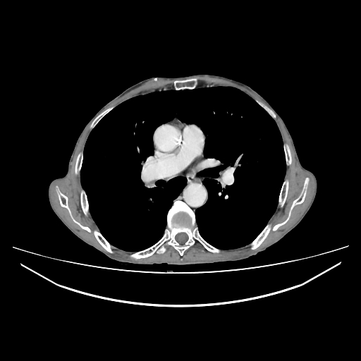 Cerebellar metastasis - lung tumor (Radiopaedia 69317-79150 A 17).jpg
