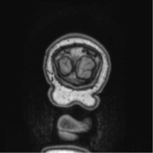 Cerebellar metastasis from lung adenocarcinoma (Radiopaedia 86690-102829 Coronal T1 4).png