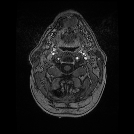 Cerebellar metastasis of pulmonary adenocarcinoma, cavernous venous malformation, and developmental venous anomaly (Radiopaedia 85827-101661 Axial T1 C+ 6).jpg