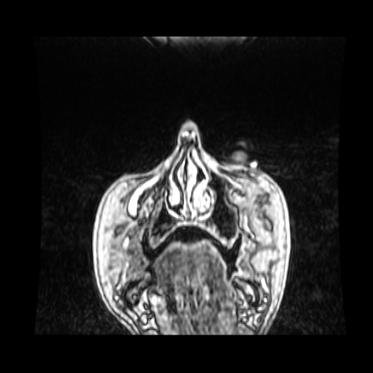 Cerebellar metastasis of pulmonary adenocarcinoma, cavernous venous malformation, and developmental venous anomaly (Radiopaedia 85827-101661 Coronal T1 C+ 94).jpg