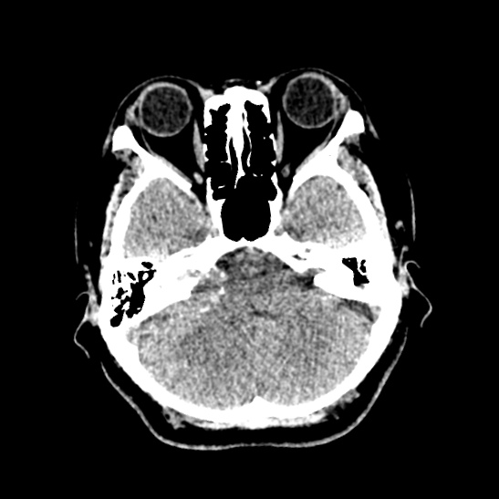 Cerebellopontine angle meningioma (Radiopaedia 53561-59592 Axial non-contrast 17).jpg